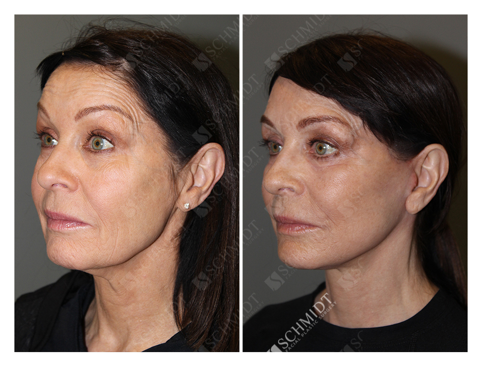 6471 Schmidt Facial Plastic Surgery
