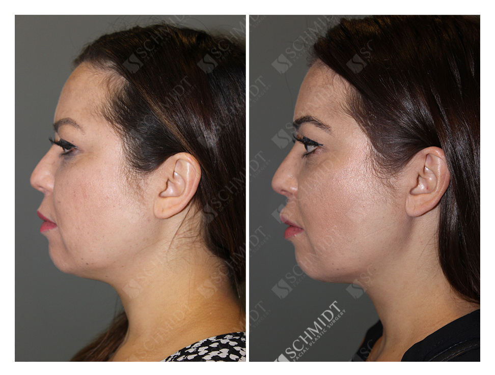 buccal fat removal 10 years later buccal fat removal 10 years later