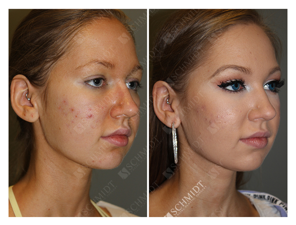 buccal fat removal 10 years later buccal fat removal 10 years later