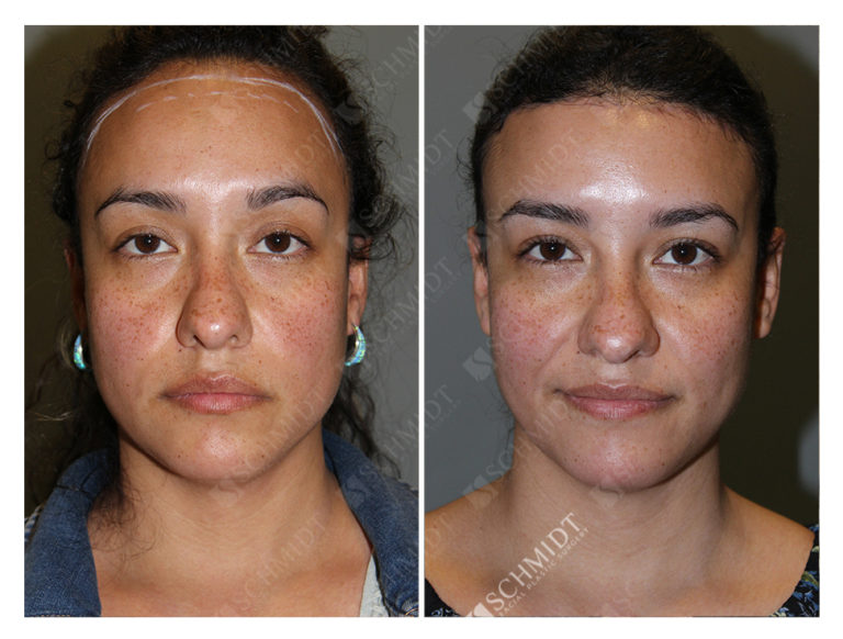 Forehead Reduction Archives Schmidt Facial Plastic Surgery