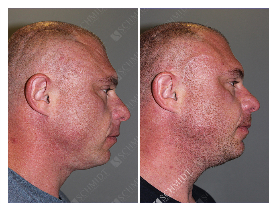 7713 Schmidt Facial Plastic Surgery