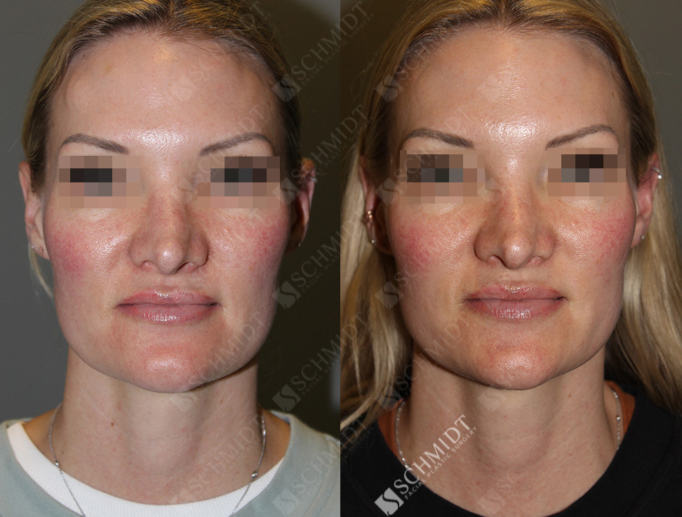 8643 Schmidt Facial Plastic Surgery
