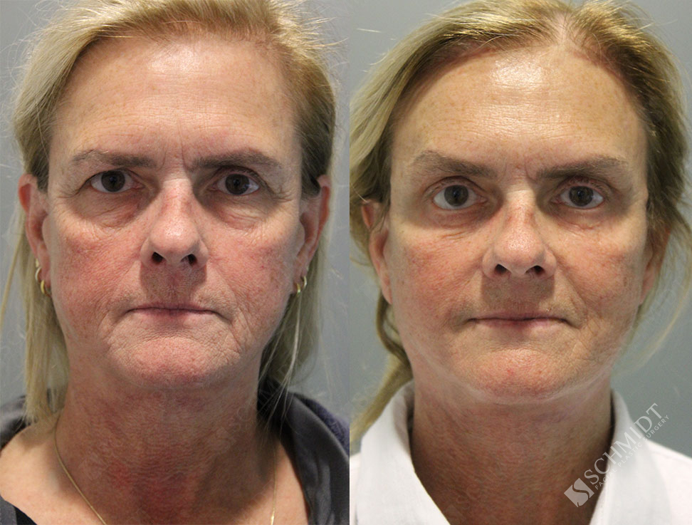 9005 Schmidt Facial Plastic Surgery(02)
