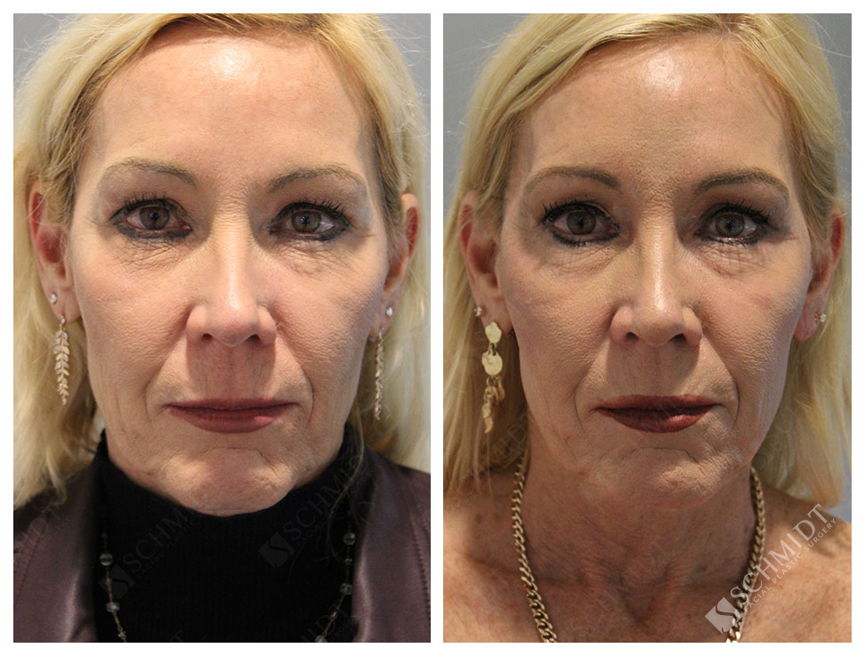 9034 Schmidt Facial Plastic Surgery